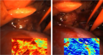 Surgical image of a kidney, the oxygen saturation calculated by the MSI system is shown at the bottom of each image.