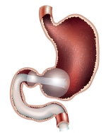 Illustration of the positioning of the barrier at the stomach outlet.